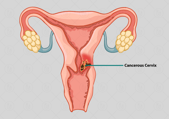 महिलाओं में गर्भाशय कैंसर अब नहीं होगा लाइलाज, 14 वर्ष की बालिकाओं को लगेगा एचपीवी टीका, डाॅ. धन सिंह रावत।